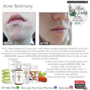 Acne Testimony - Althea's Clear Skin Journey