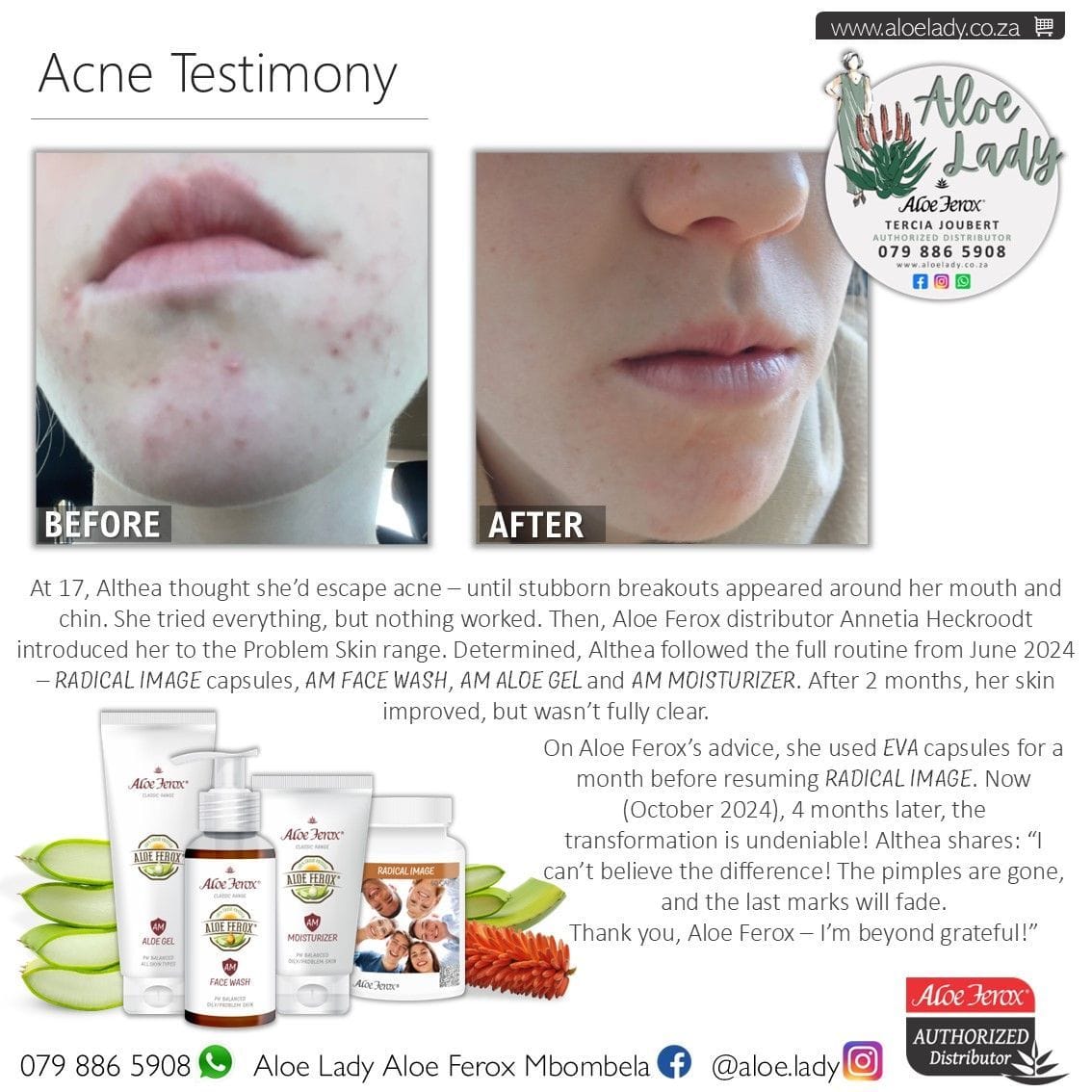 Acne Testimony – Althea’s Clear Skin Journey