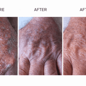 Lourens | Severe Sun Damage Testimonial
