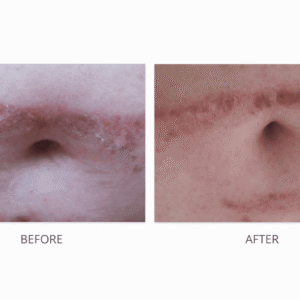 Super Aloe Gel – Burn Healing Testimonial